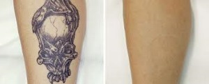 Skinfinity Laser and Beauty — laser tattoo removal clinic in Brighton