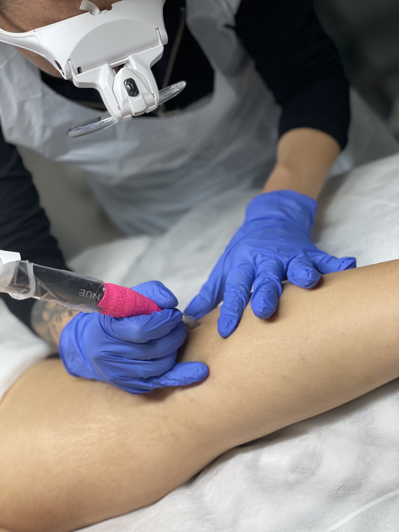 B&S Cosmetic Tattooing - stretch mark & scar treatment, camouflage tattoo in Secret Harbour — laser tattoo removal clinic in Secret Harbour