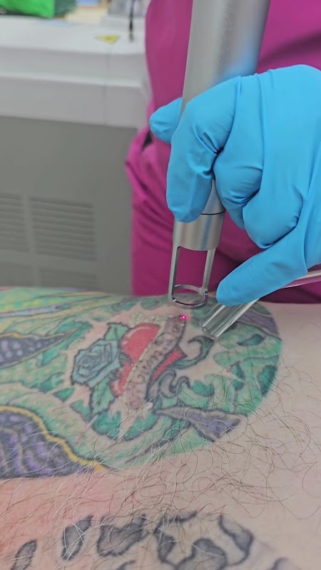 Outer Ink Laser Tattoo Removal β laser tattoo removal clinic in Ashmore