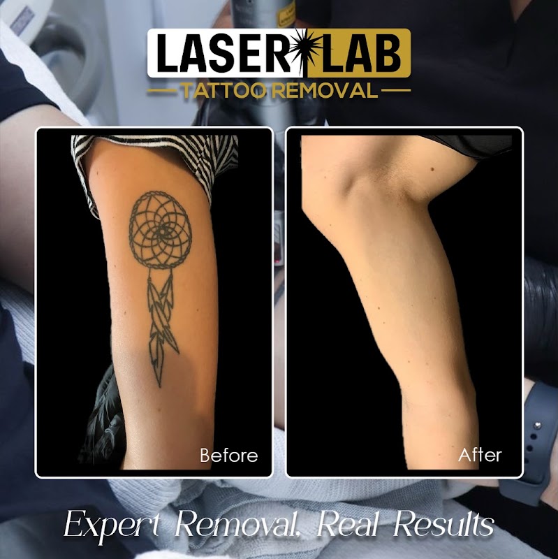 Laser Lab Tattoo Removal Cairns β laser tattoo removal clinic in Cairns City