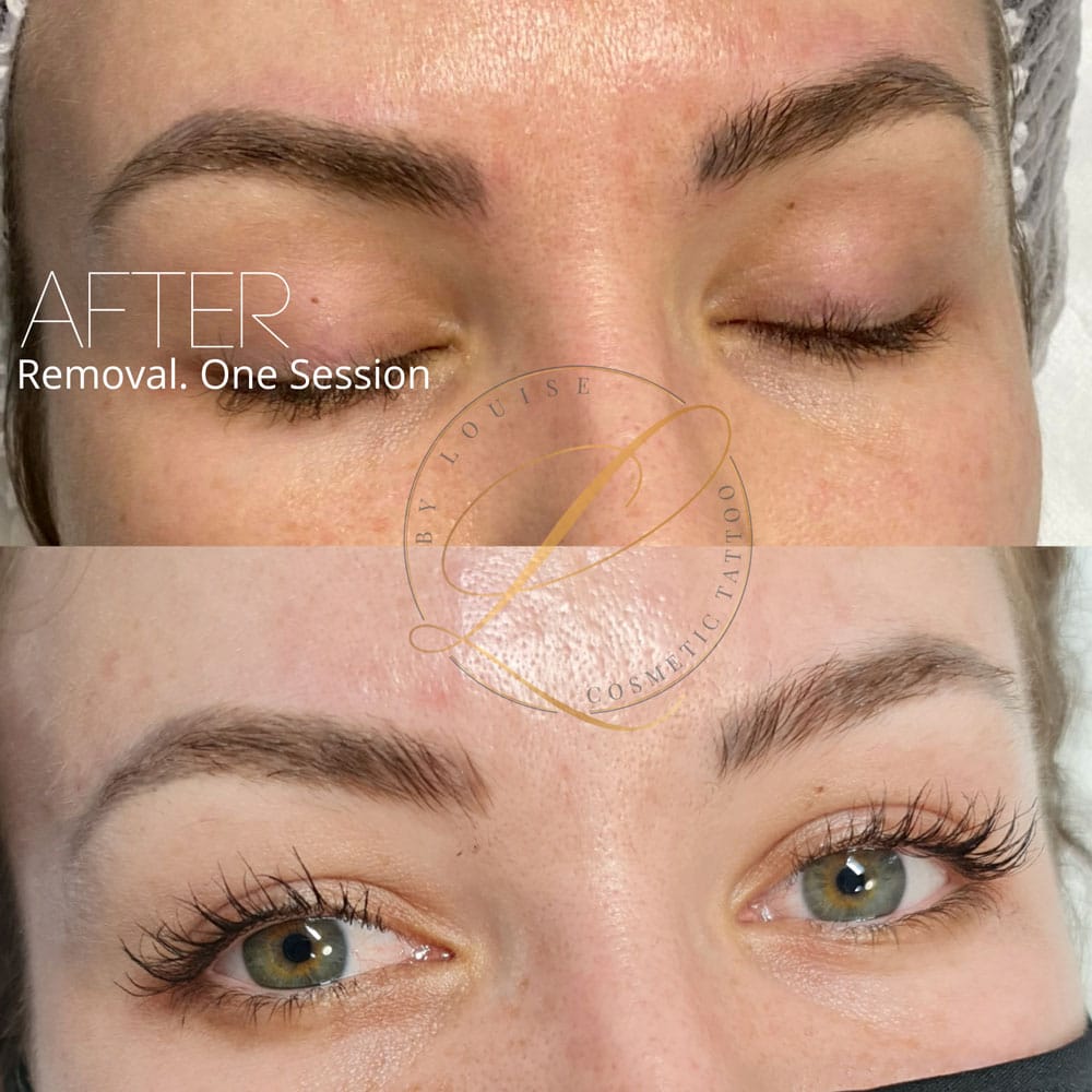 Cosmetic & Medical Tattooist By Louise Ballarat — laser tattoo removal clinic in Wendouree