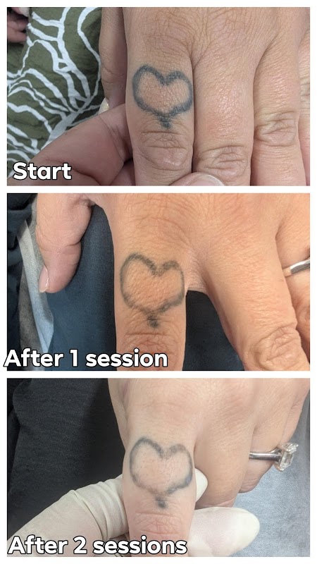 Reverse-A-Tat — laser tattoo removal clinic in Browns Plains
