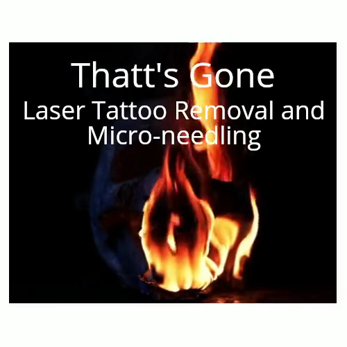 ThATT's GONE Laser Tattoo Removal — laser tattoo removal clinic in Parafield Gardens