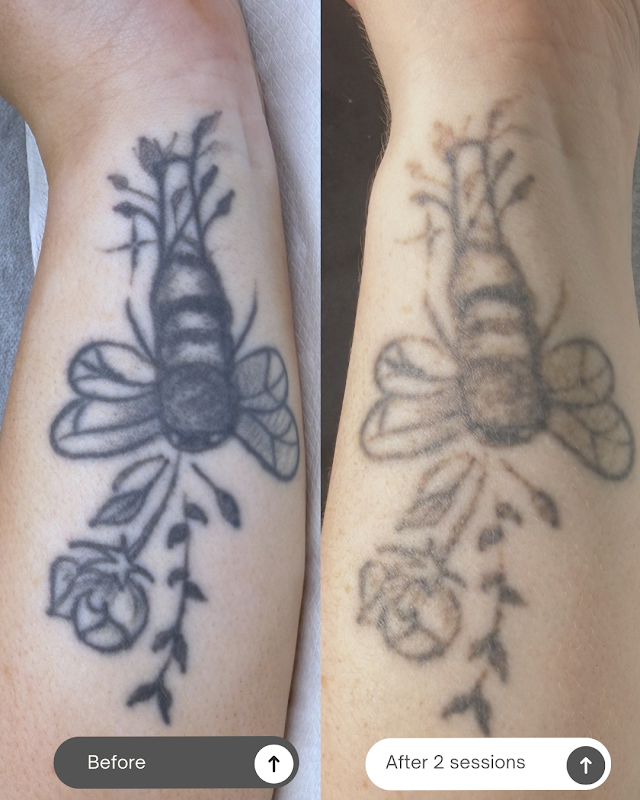 Clear View Tattoo Removal — laser tattoo removal clinic in Christie Downs