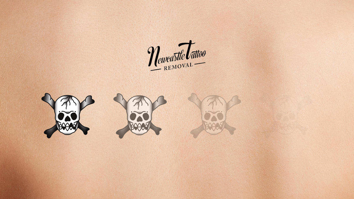Newcastle Tattoo Removal β laser tattoo removal clinic in Cooks Hill