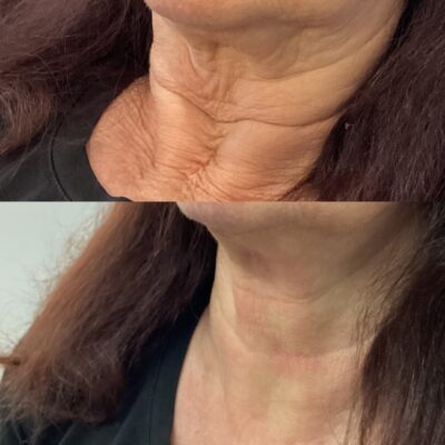 E.W. Cosmetic Injector and Laser Clinics - Lawnton — laser tattoo removal clinic in Lawnton