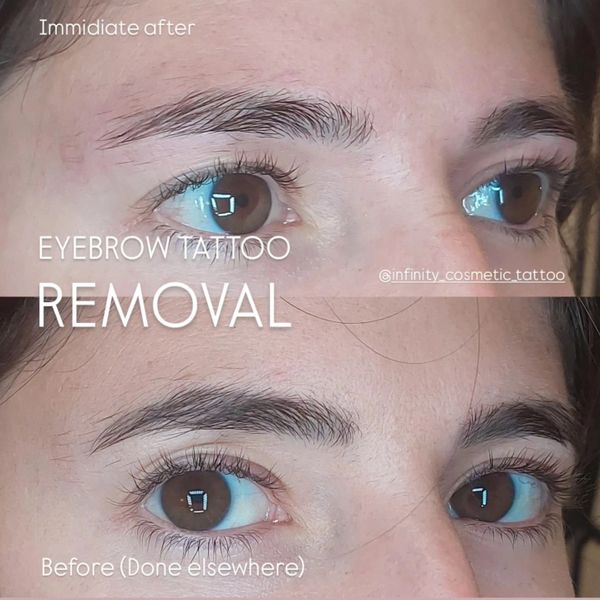 Pico Laser Tattoo Removal Gold Coast — laser tattoo removal clinic in Mudgeeraba