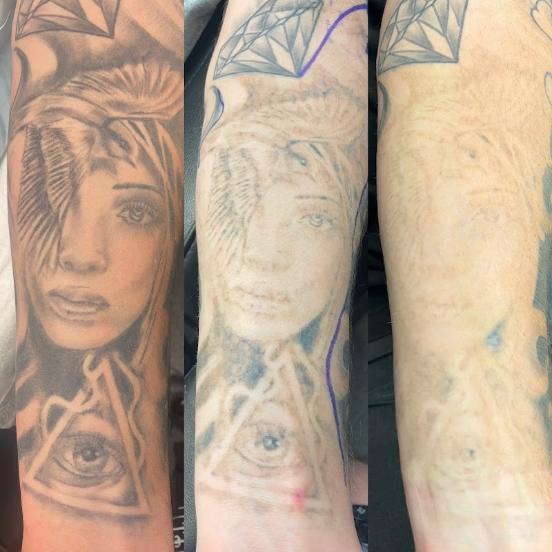 Lazer & Co. β laser tattoo removal clinic in Warana