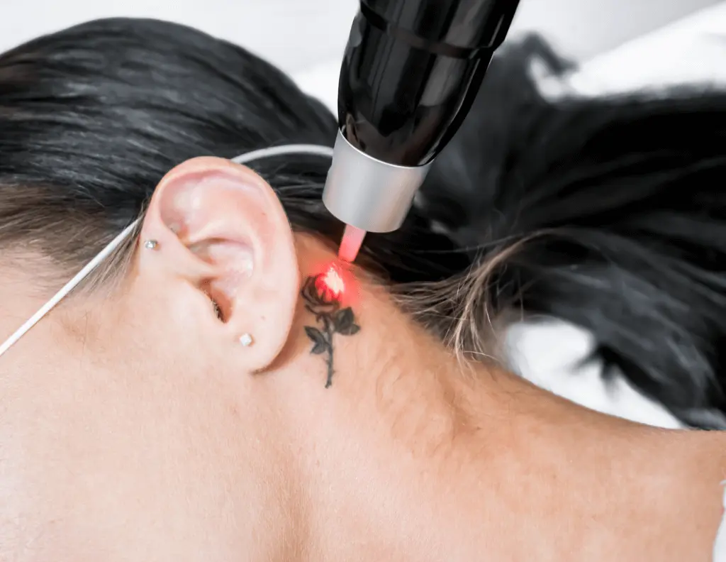 Skin Artistry Pty Ltd | Hifu 7 Treatment Blackburn | Tattoo removal | Permanent Makeup — laser tattoo removal clinic in Blackburn