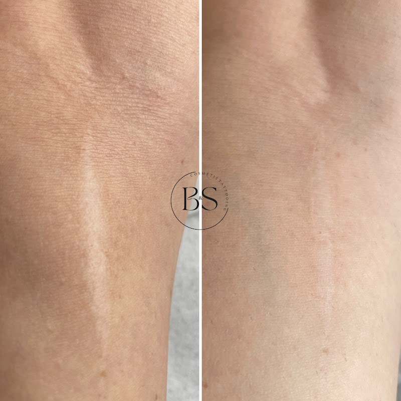 B&S Cosmetic Tattooing Perth โ laser tattoo removal clinic in West Perth