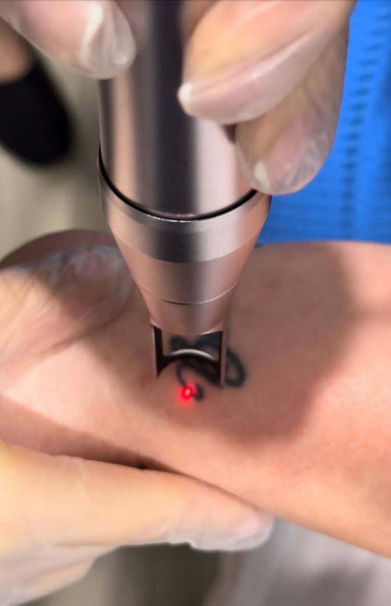 Coastal Aesthetics and Wellbeing — laser tattoo removal clinic in Taree