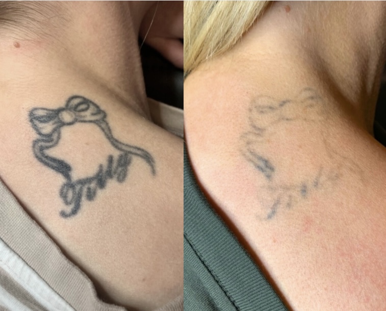 TATTS ON TATTS OFF — laser tattoo removal clinic in Cheltenham
