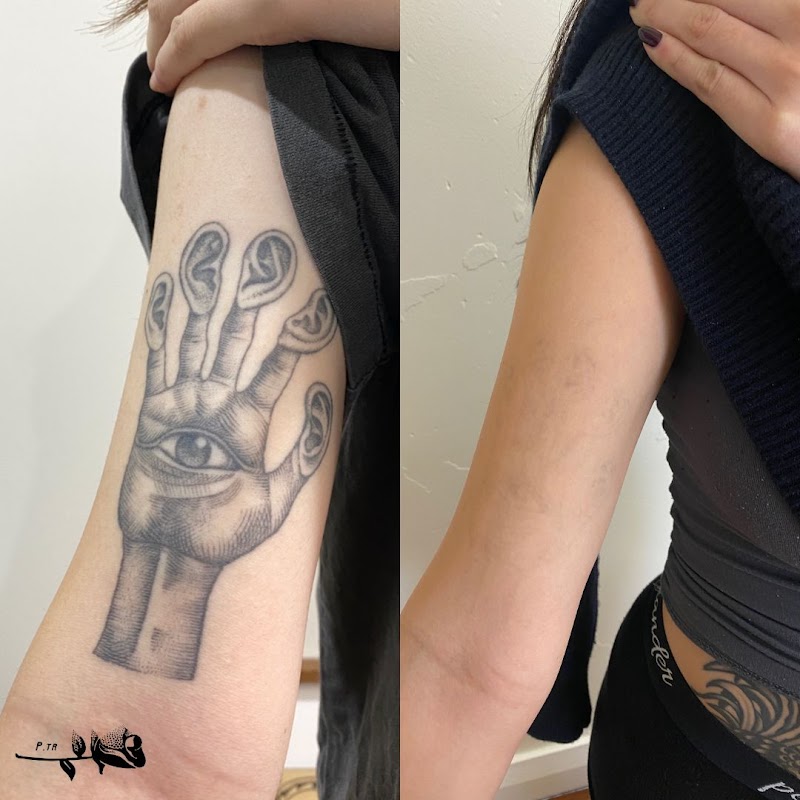 Paramount Tattoo Removal — laser tattoo removal clinic in Marrickville
