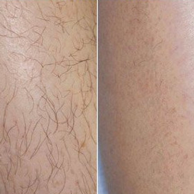 ABA Cosmetic — laser tattoo removal clinic in Pymble