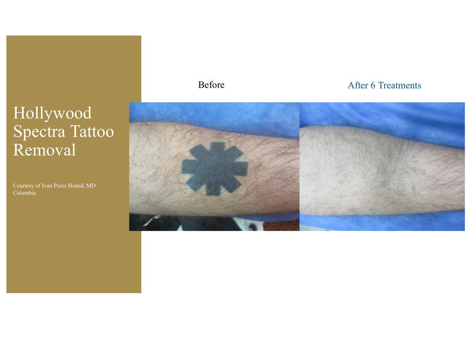 surry hills laser โ laser tattoo removal clinic in Surry Hills
