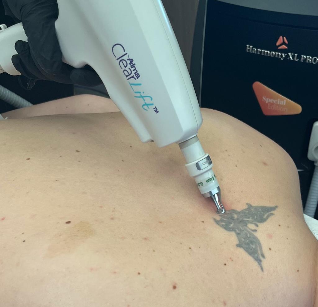 Elfreda Beauty Clinic Chatswood — laser tattoo removal clinic in Chatswood