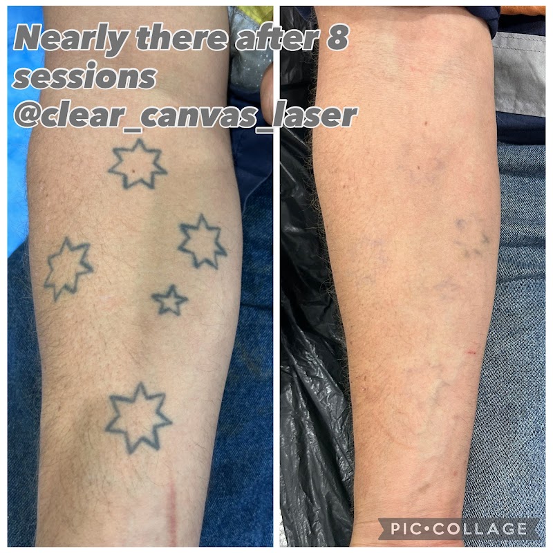 Clear Canvas Laser Tattoo Removal — laser tattoo removal clinic in Nambour