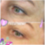 Lazer Erazer Collingwood — laser tattoo removal clinic in Collingwood