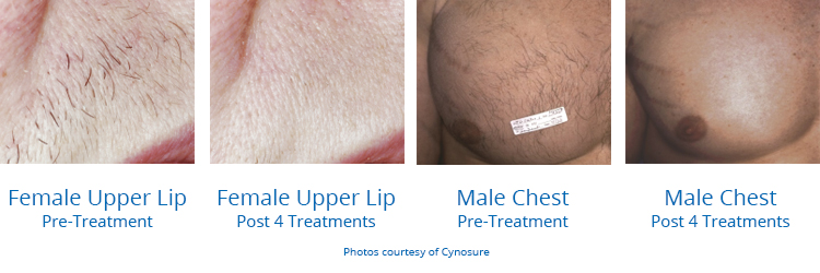 Lasercare — laser tattoo removal clinic in St Leonards