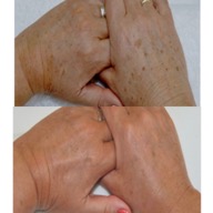 Enhance Skin Care — laser tattoo removal clinic in Canberra