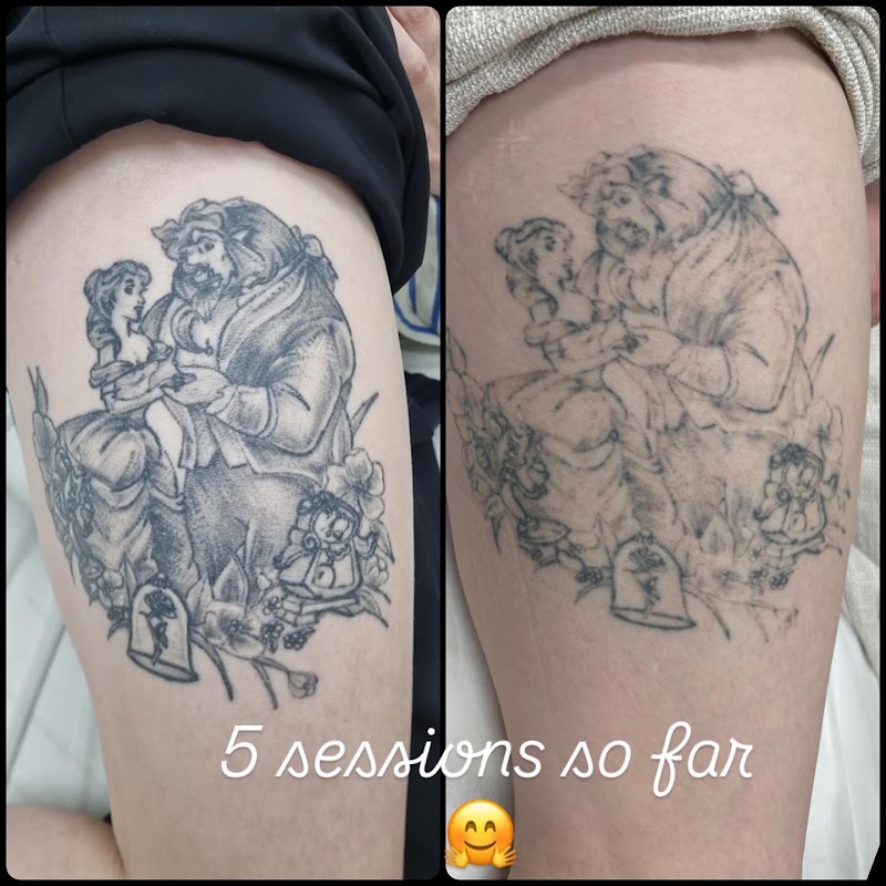 Laserpro Tattoo Removal โ laser tattoo removal clinic in Shellharbour
