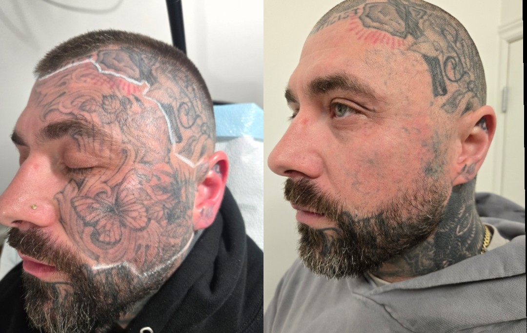 Ethereal Tattoos and Laser Removal — laser tattoo removal clinic in Halifax