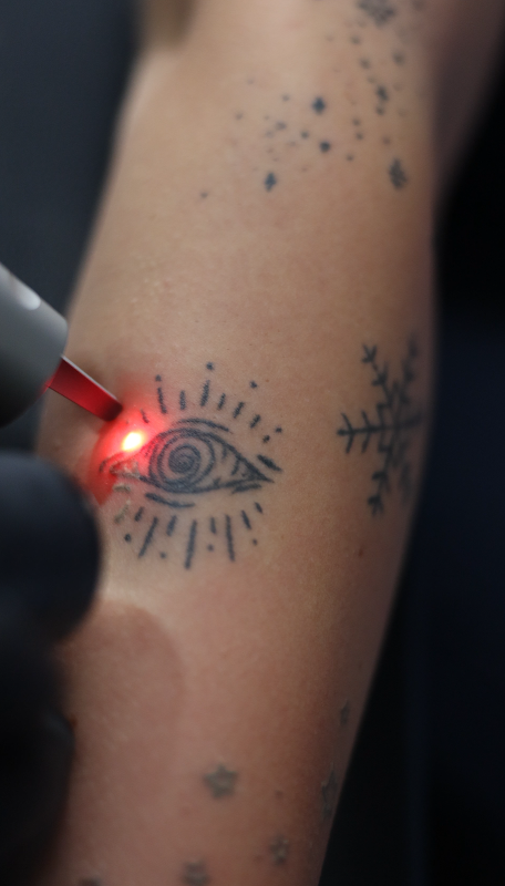 Toronto Tattoo Removal — laser tattoo removal clinic in Toronto