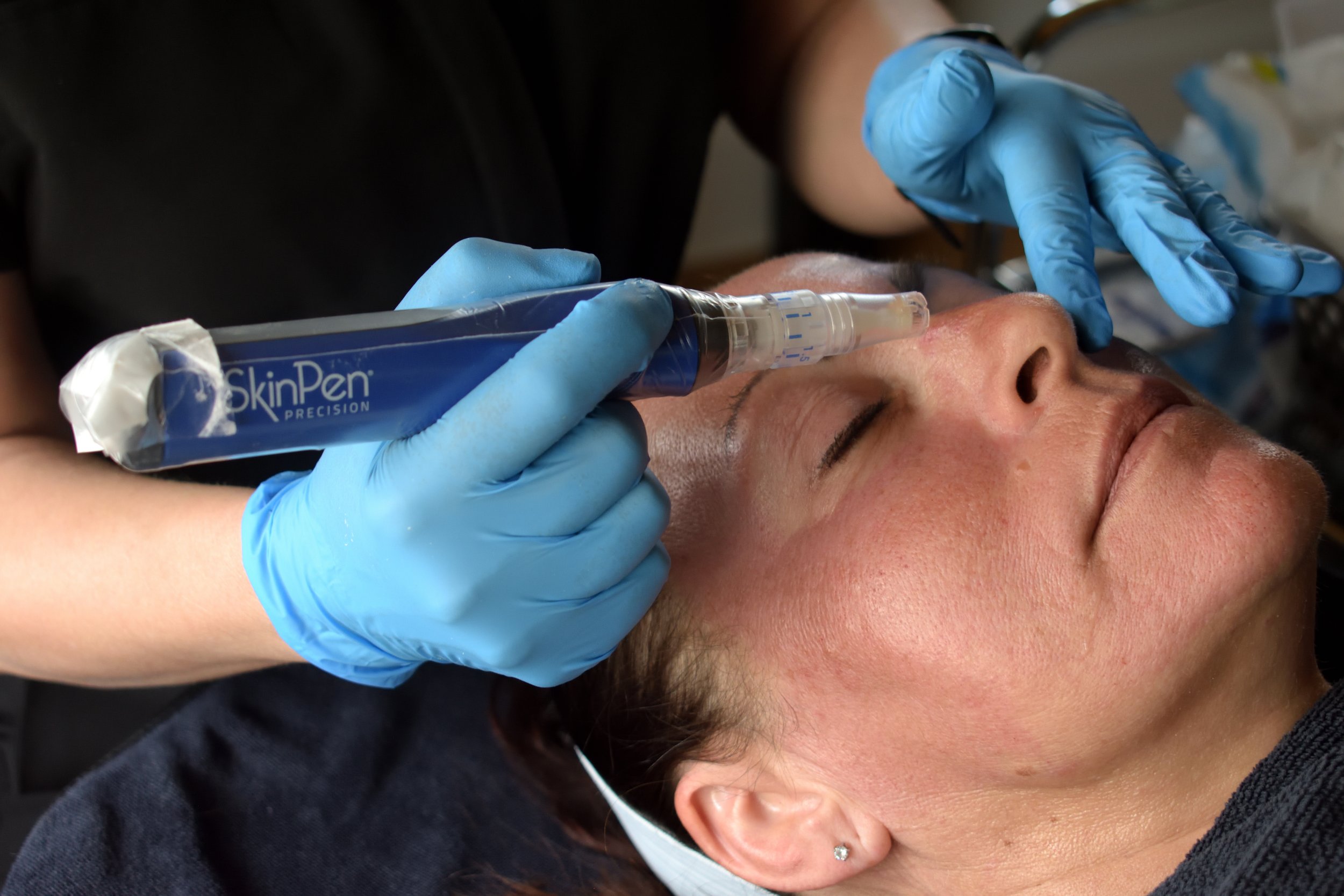 Bare Envy Laser β laser tattoo removal clinic in Regina