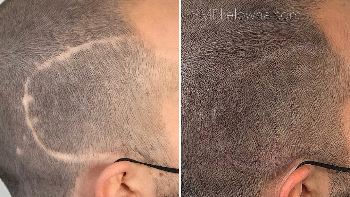 Advanced Technique Paramedical Clinc SMP + SCAR CAMOUFLAGE β laser tattoo removal clinic in Kelowna