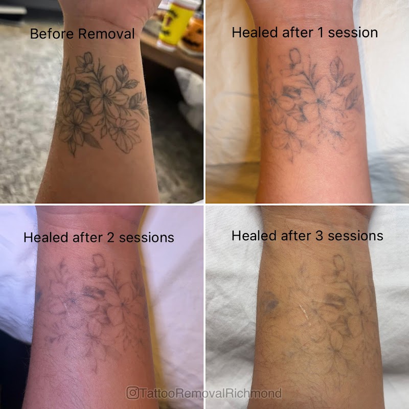Tattoo Removal Richmond — laser tattoo removal clinic in Richmond