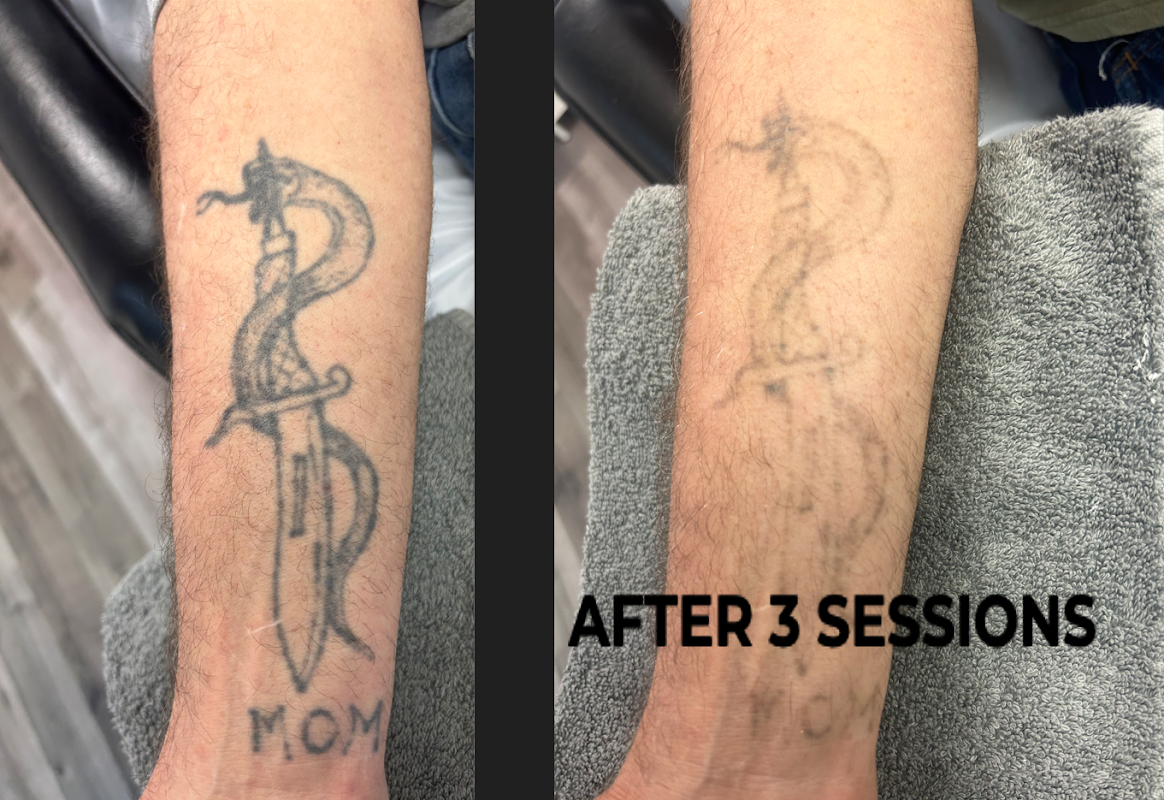 Brantford Laser Clinic — laser tattoo removal clinic in Brantford