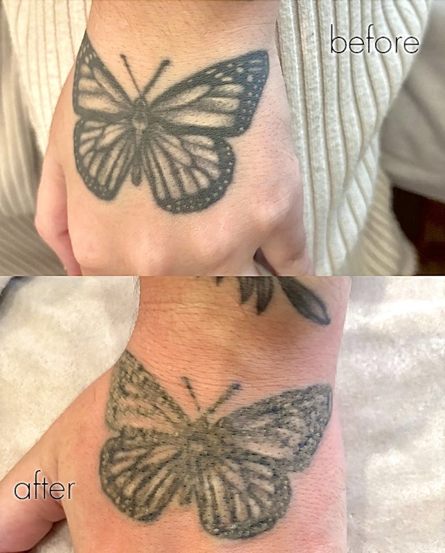 Haze London — laser tattoo removal clinic in London