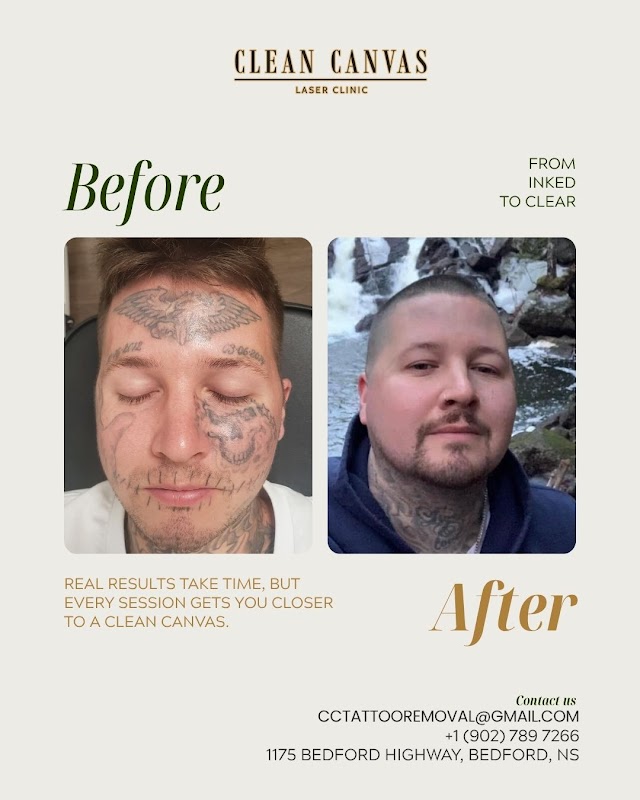 Clean Canvas Tattoo Removal β laser tattoo removal clinic in Bedford