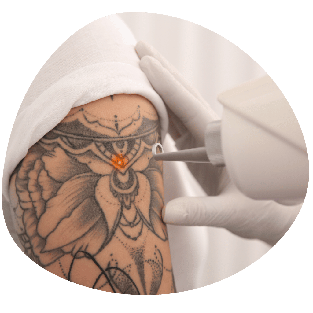 Hannah Beauty Studio — laser tattoo removal clinic in London