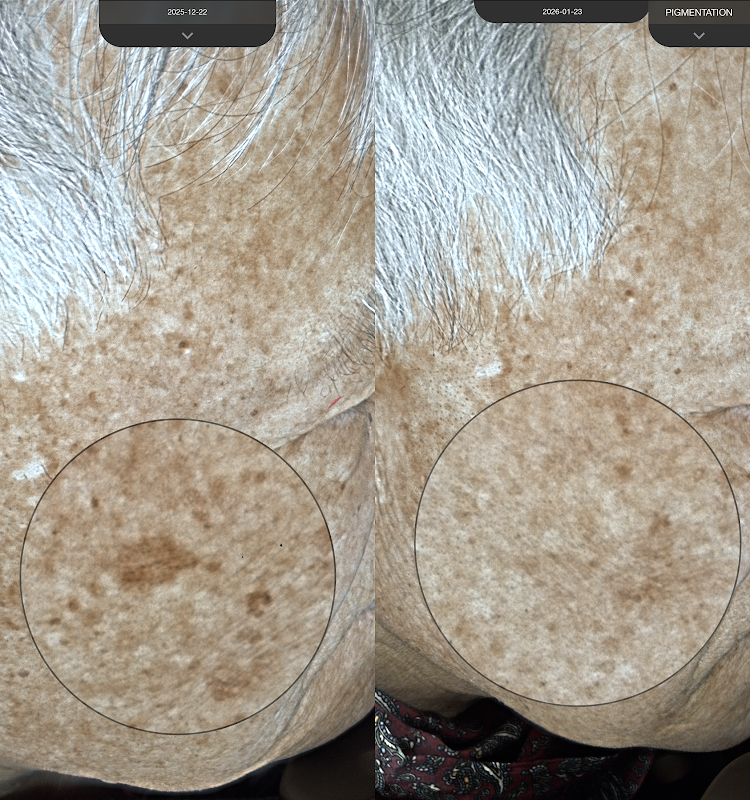 Pain Free Laser and Hair Restoration Clinic — laser tattoo removal clinic in Niagara Falls