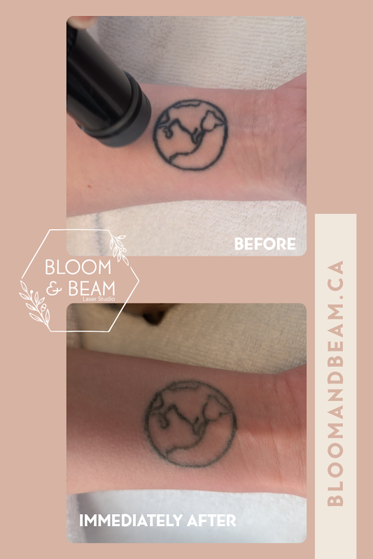 Bloom & Beam Inc. β laser tattoo removal clinic in North Dumfries