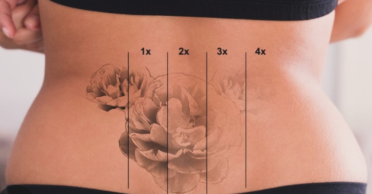 Phantom Skin โ laser tattoo removal clinic in Edmonton