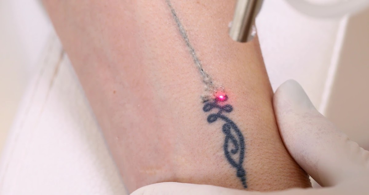 Calgary Tattoo Removal — laser tattoo removal clinic in Calgary
