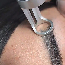 HARLOW X Laser et Détatouage Montreal — laser tattoo removal clinic in Montreal