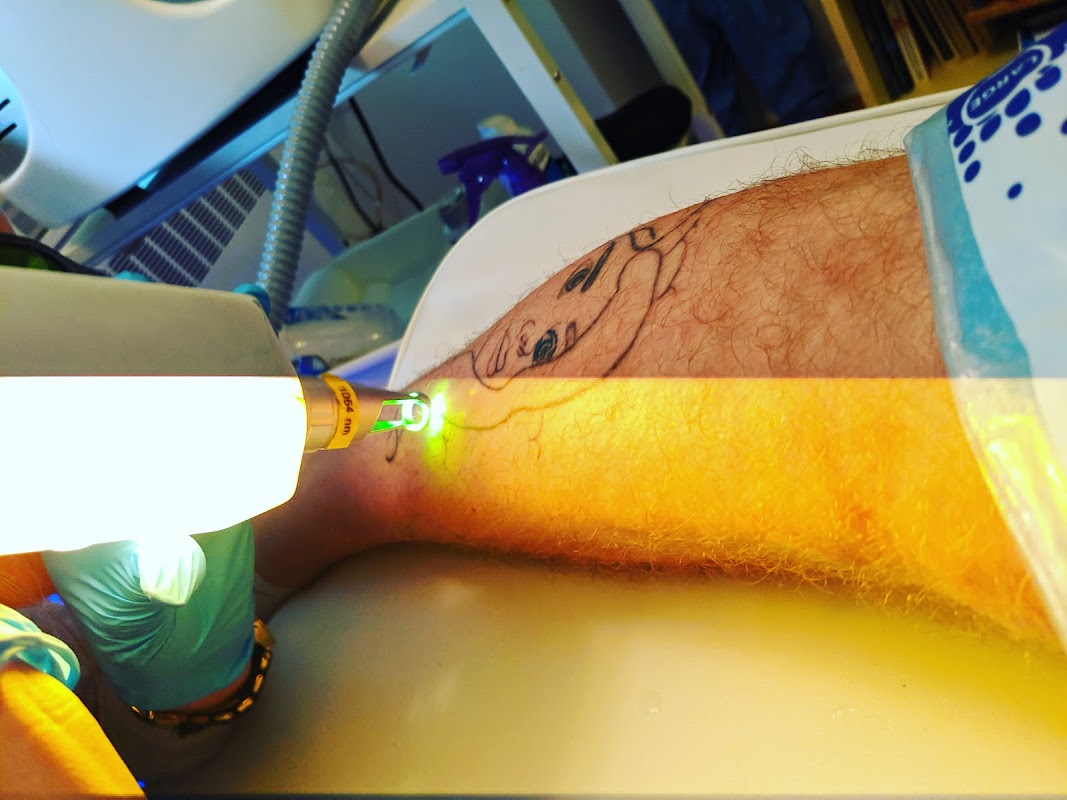 Laser Tattoo Removal — laser tattoo removal clinic in Toronto