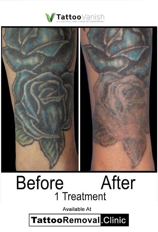 Tattoo Removal Clinic | Toronto — laser tattoo removal clinic in Toronto