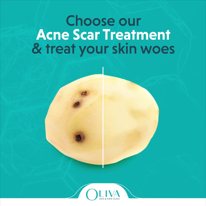Oliva Skin & Hair Clinic Secunderabad: Laser Hair Removal, Acne Scar, PRP, Hair Loss, Skin Whitening Treatments In Hyderabad — laser tattoo removal clinic in Secunderabad