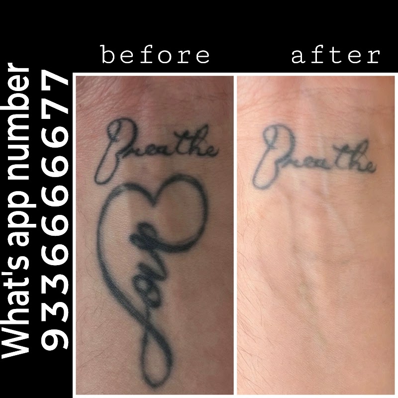 Magnet tattoo removal & Body piercing — laser tattoo removal clinic in Lucknow