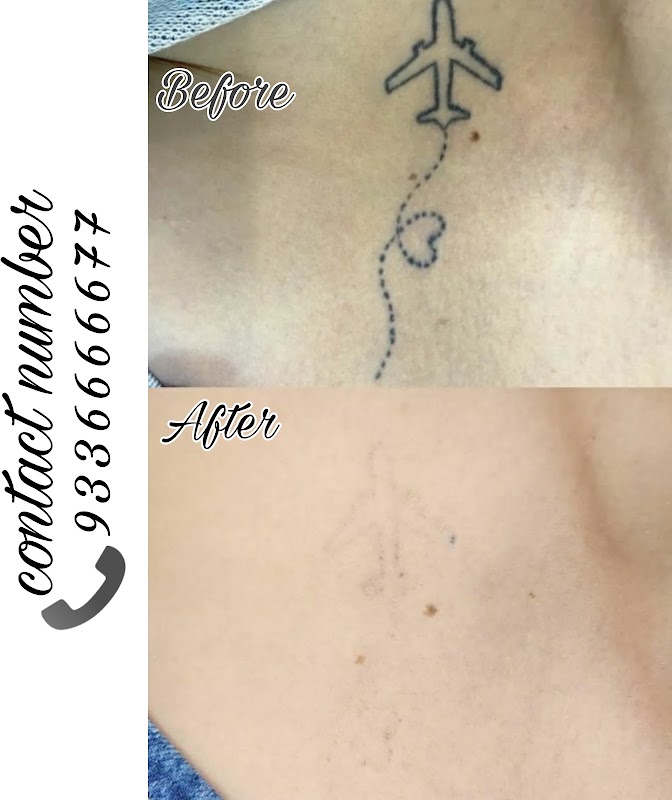 Menders Tattoo Removal & piercing lucknow — laser tattoo removal clinic in Lucknow