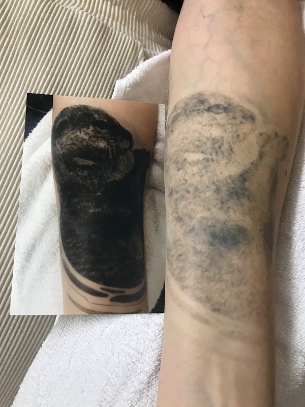 Beauty Is... β laser tattoo removal clinic in Addington