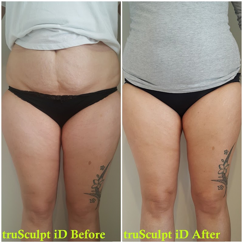 Beautilase — laser tattoo removal clinic in Totara Vale
