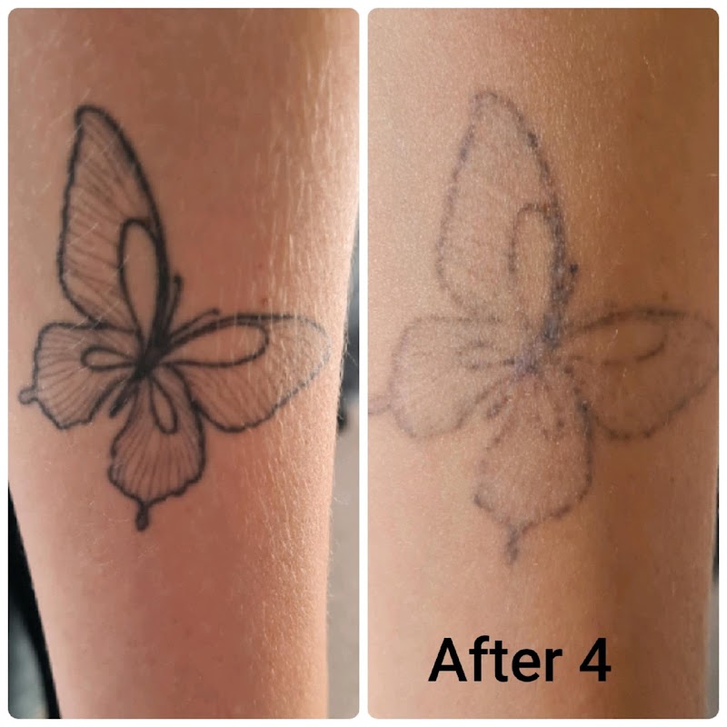 Delete Laser Tattoo Removal — laser tattoo removal clinic in Kaipātiki