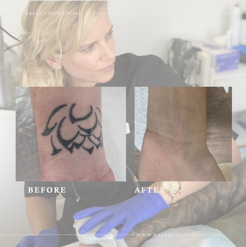 Laser HQ Tattoo removal — laser tattoo removal clinic in Mairangi Bay