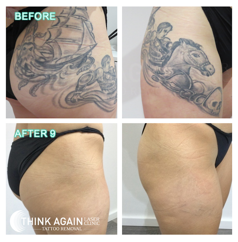 Think Again Laser Clinic - Auckland — laser tattoo removal clinic in Ponsonby