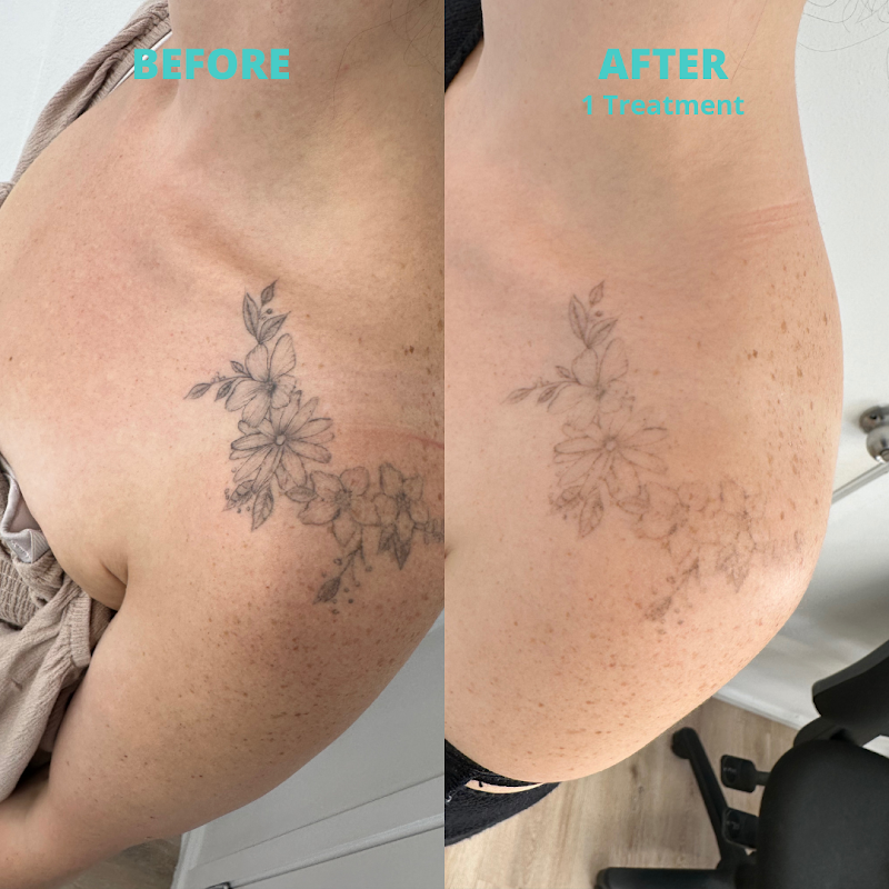 Laser Studio - Tattoo Removal Auckland — laser tattoo removal clinic in Eden Terrace